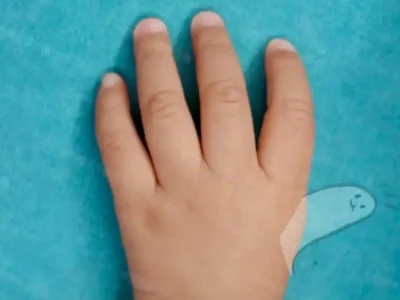 Wat moet je doen als een baby zonder duim wordt geboren? Wat als de duim te k...