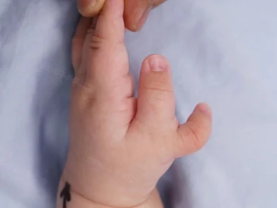 Als u de duim van uw baby na de operatie zou beoordelen, welke score zou u da...